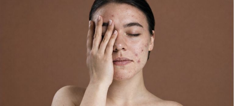 Kaitan Polusi Udara dengan Penuaan Dini Kulit